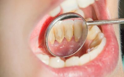 ¿Cómo afecta el sarro a mis dientes?