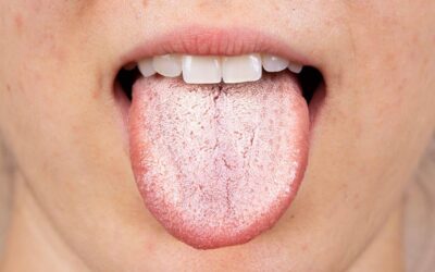 ¿Qué es Candidiasis Oral?