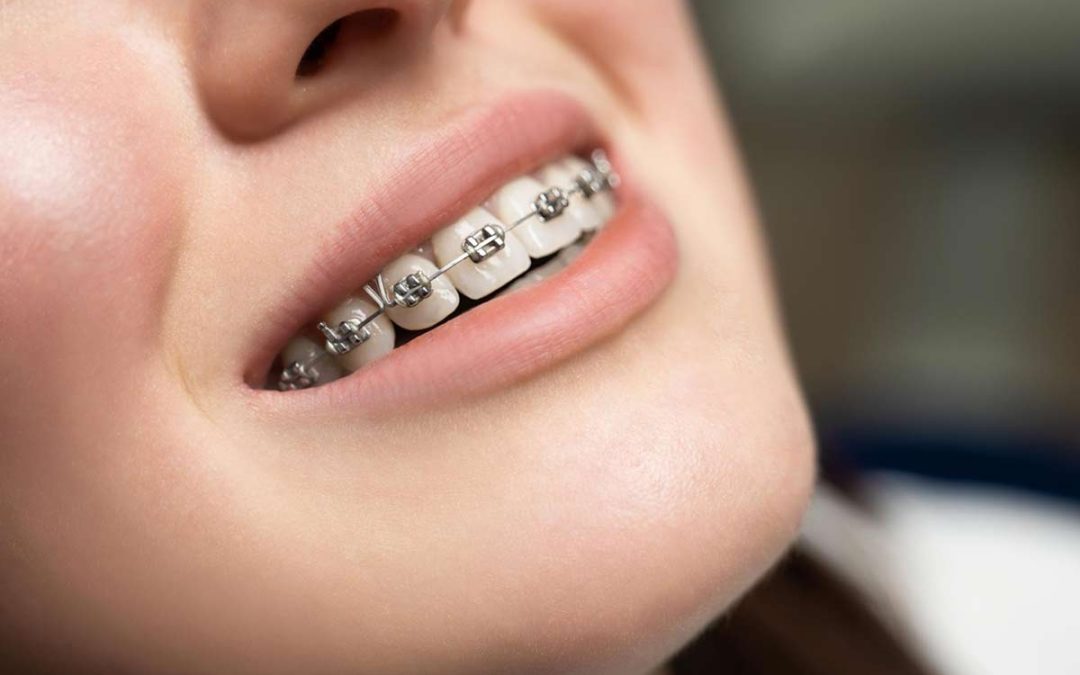 Cómo mantener una buena higiene dental en los brackets