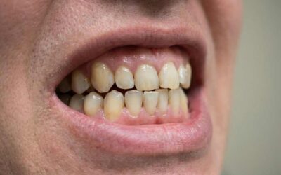 ¿Por qué se tuercen los dientes?